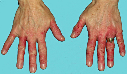 Everything you need to know about Allergic dermatitis or contact dermatitis